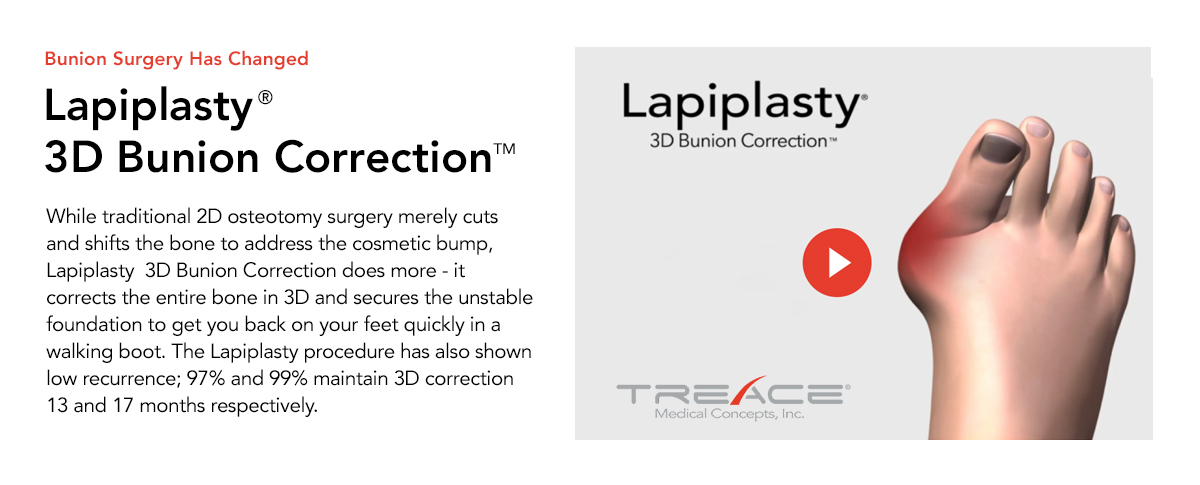 Lapiplasty 3D Bunion Correction treatment options at Family Footcare Connecticut